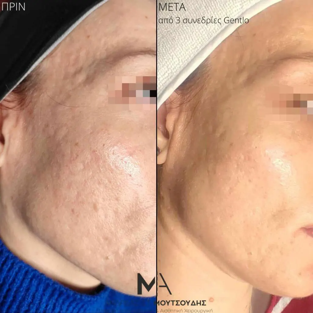Εφαρμογή του Gentlo αληθινές φωτογραφίες Πριν και Μετά