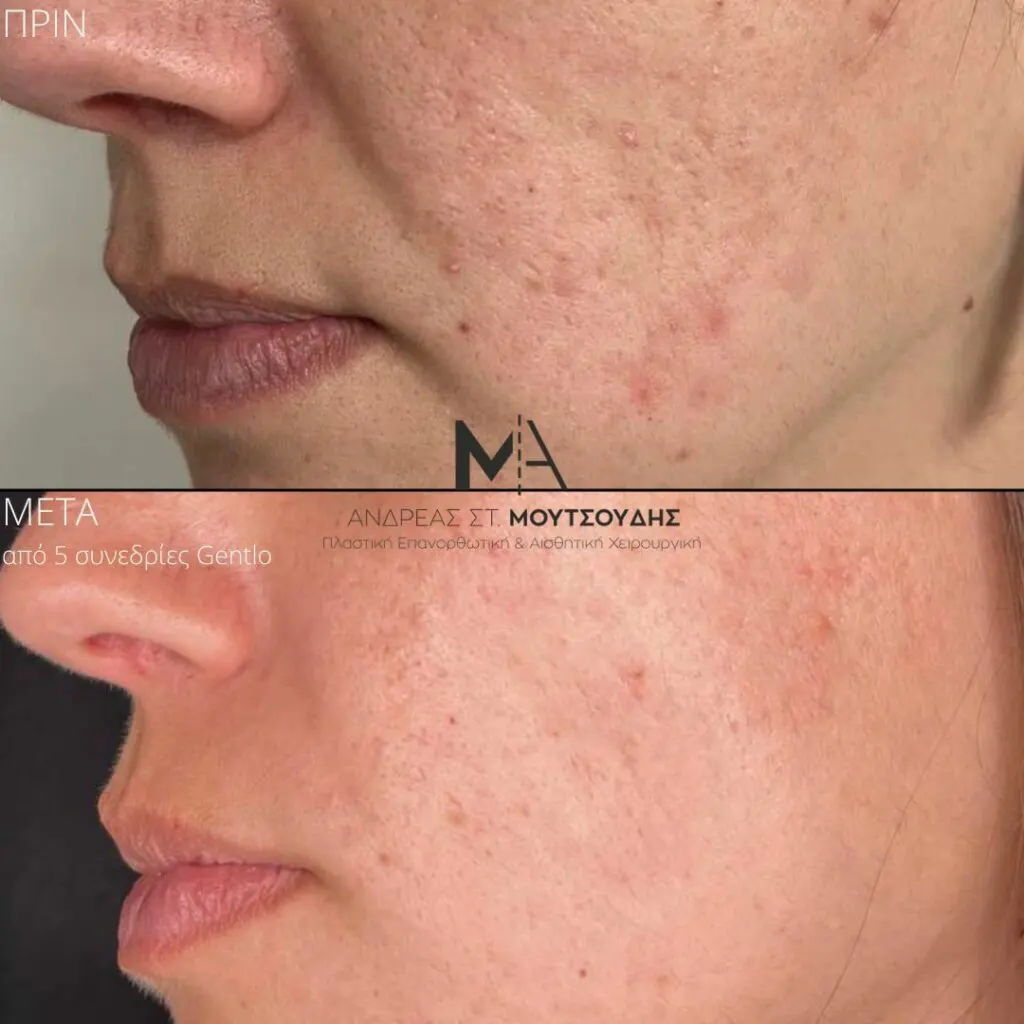 Εφαρμογή του Gentlo αληθινές φωτογραφίες Πριν και Μετά