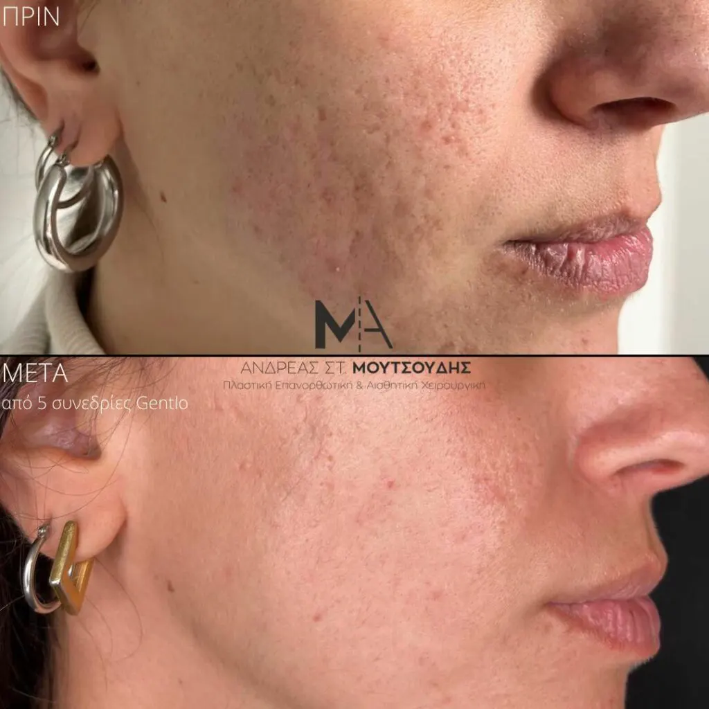 Εφαρμογή του Gentlo αληθινές φωτογραφίες Πριν και Μετά