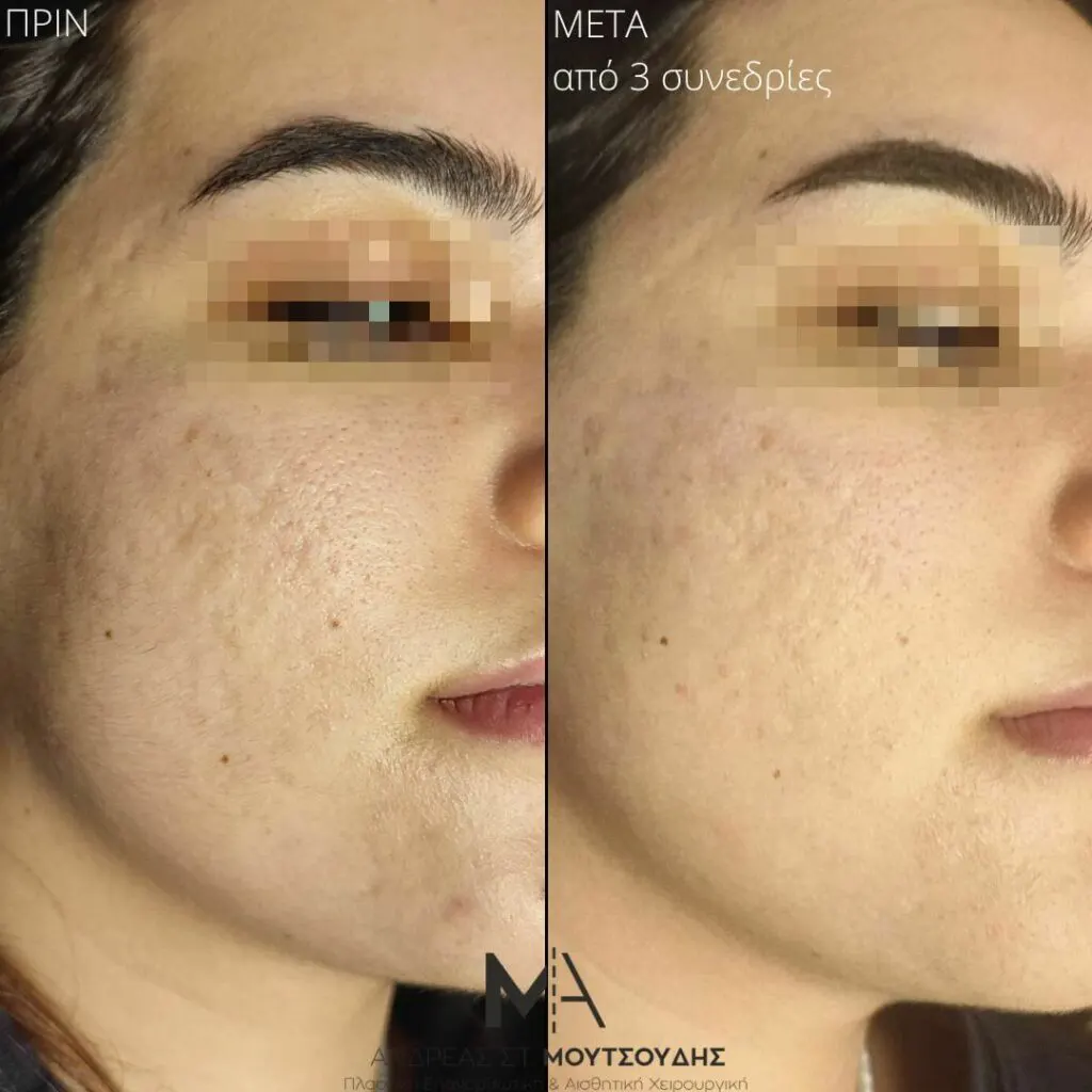 Εφαρμογή του Gentlo αληθινές φωτογραφίες Πριν και Μετά