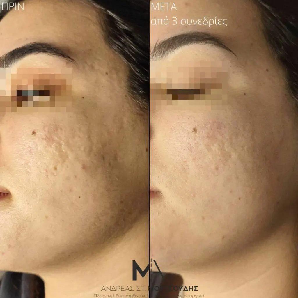 Εφαρμογή του Gentlo αληθινές φωτογραφίες Πριν και Μετά