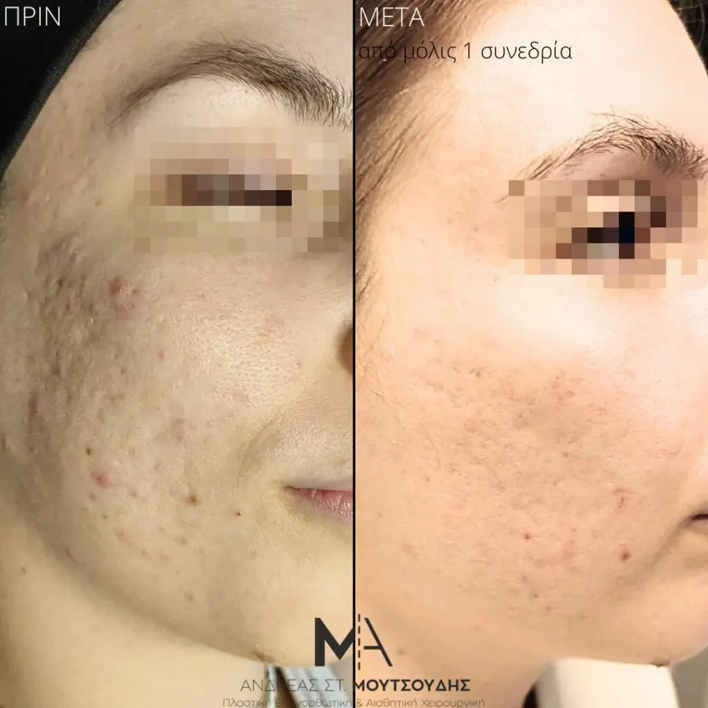 Εφαρμογή του Gentlo αληθινές φωτογραφίες Πριν και Μετά