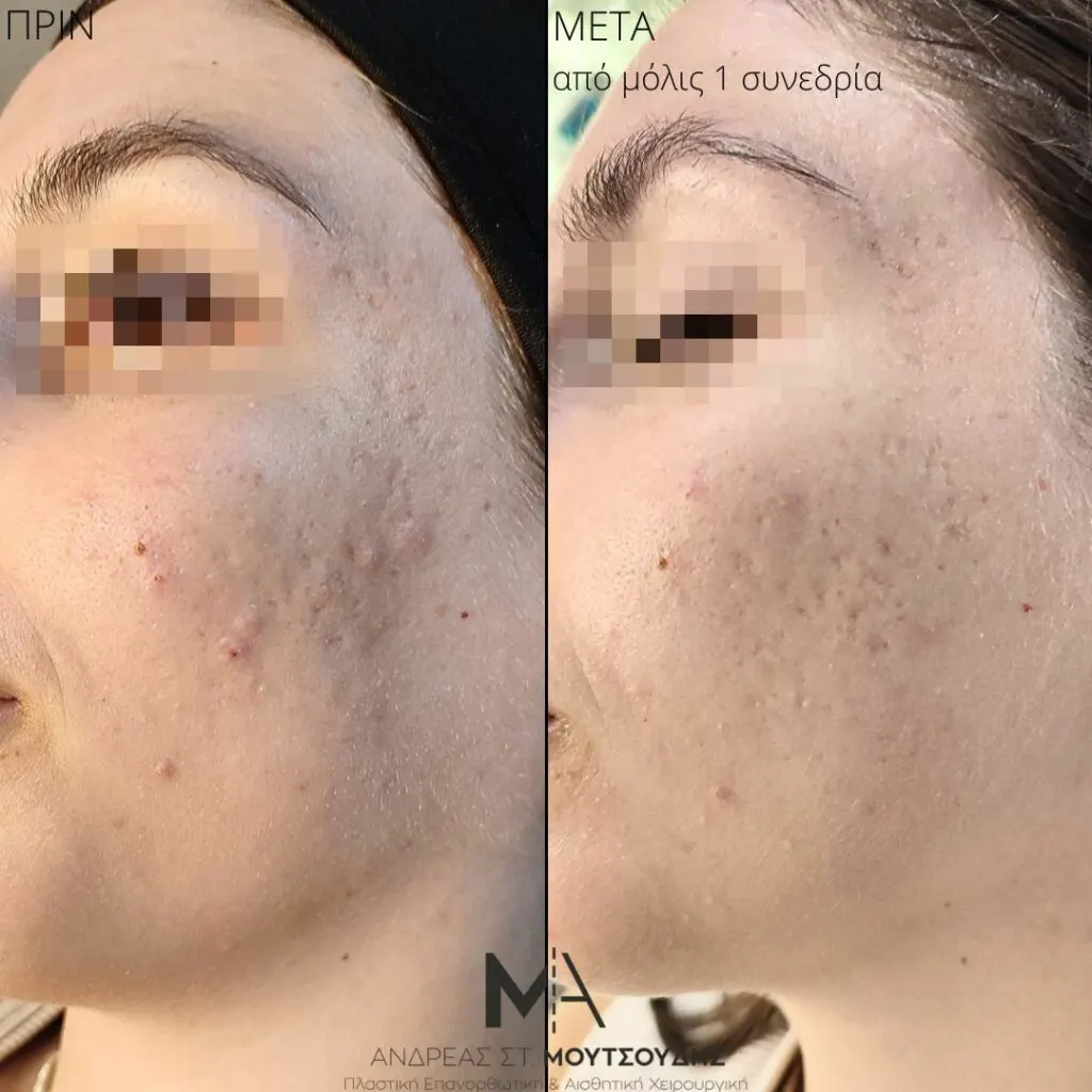 Εφαρμογή του Gentlo αληθινές φωτογραφίες Πριν και Μετά