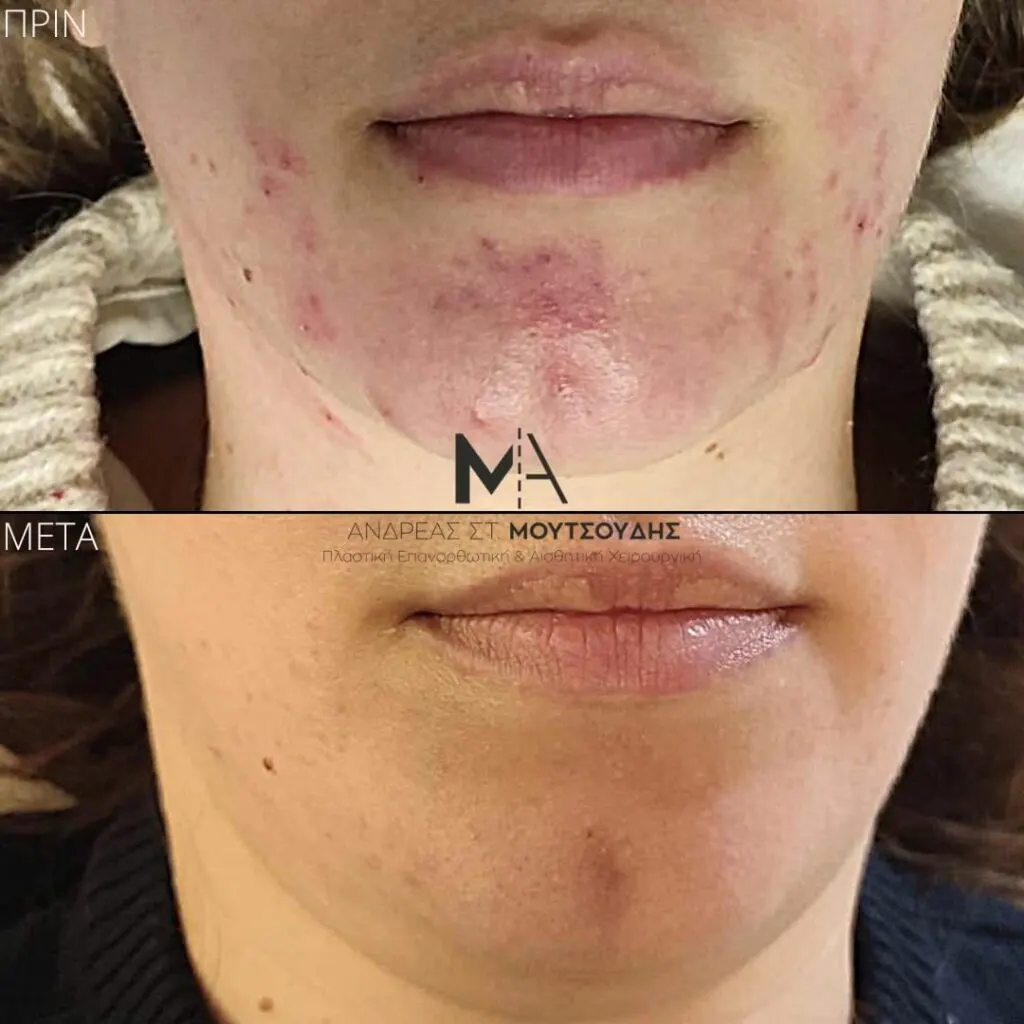 Εφαρμογή του Gentlo αληθινές φωτογραφίες Πριν και Μετά