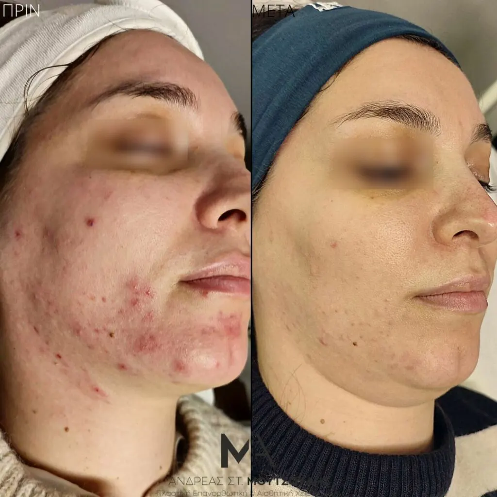 Εφαρμογή του Gentlo αληθινές φωτογραφίες Πριν και Μετά