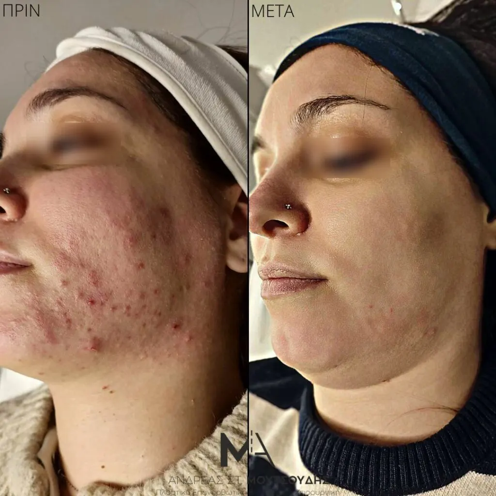 Εφαρμογή του Gentlo αληθινές φωτογραφίες Πριν και Μετά