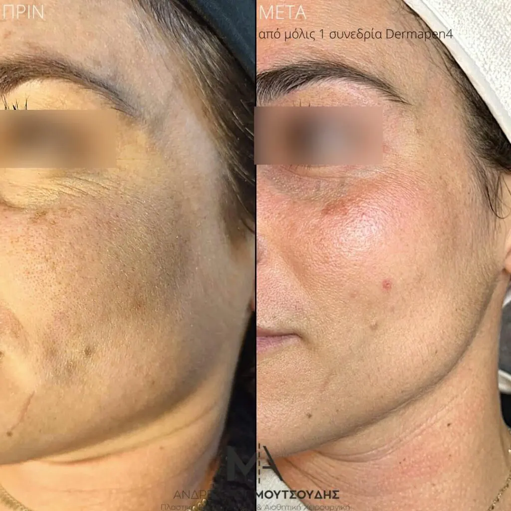 Εφαρμογή του Gentlo αληθινές φωτογραφίες Πριν και Μετά