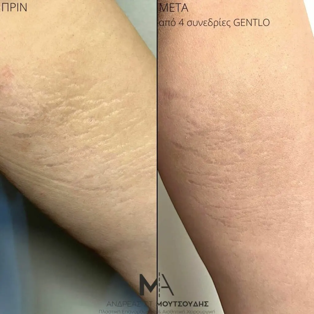 Εφαρμογή του Gentlo αληθινές φωτογραφίες Πριν και Μετά