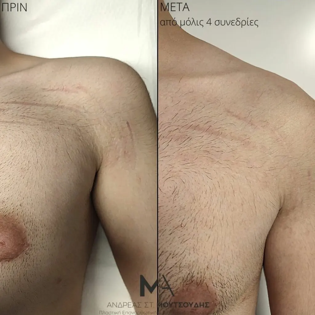 Εφαρμογή του Gentlo αληθινές φωτογραφίες Πριν και Μετά