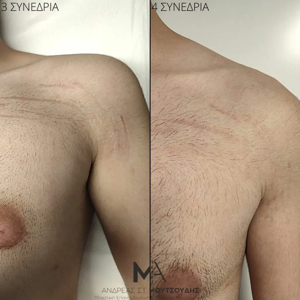 Εφαρμογή του Gentlo αληθινές φωτογραφίες Πριν και Μετά