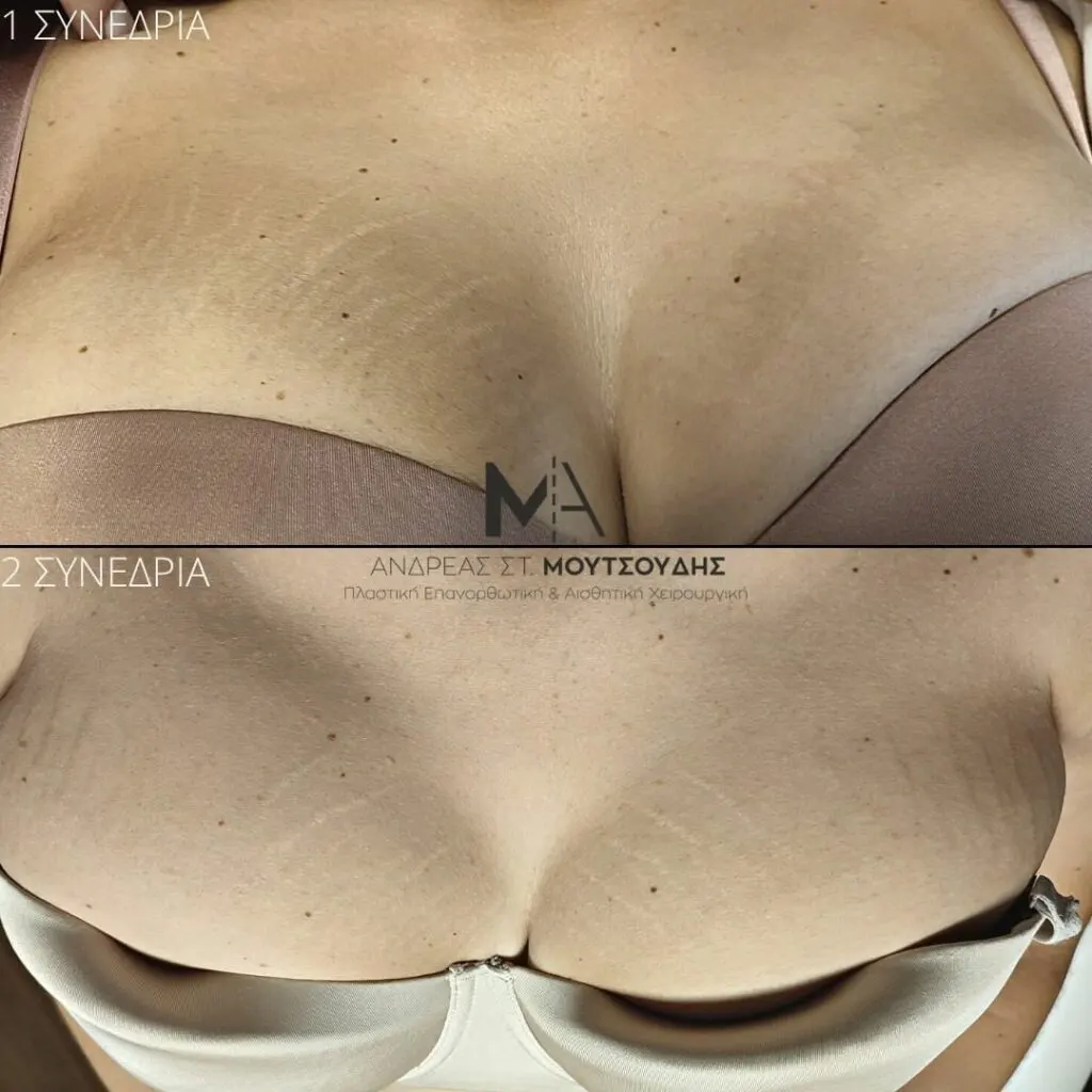 Εφαρμογή του Gentlo αληθινές φωτογραφίες Πριν και Μετά