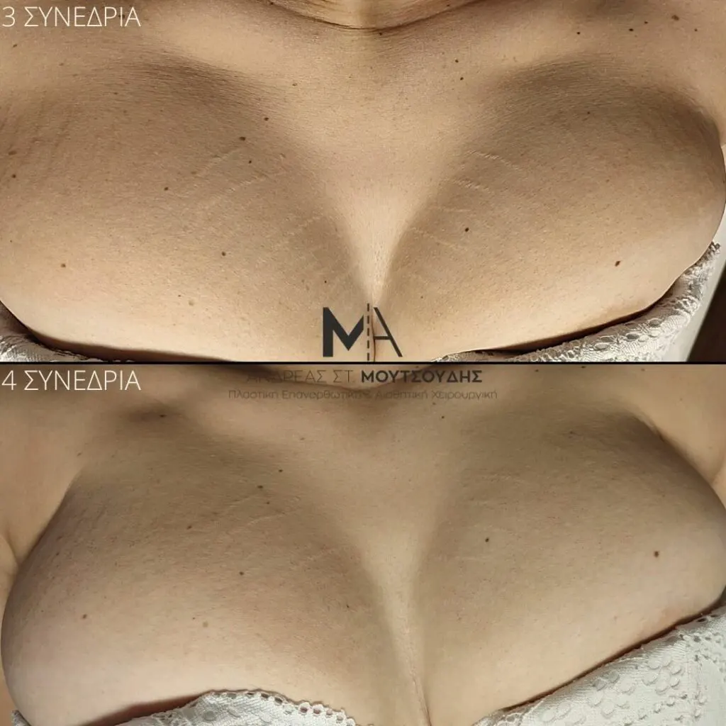 Εφαρμογή του Gentlo αληθινές φωτογραφίες Πριν και Μετά