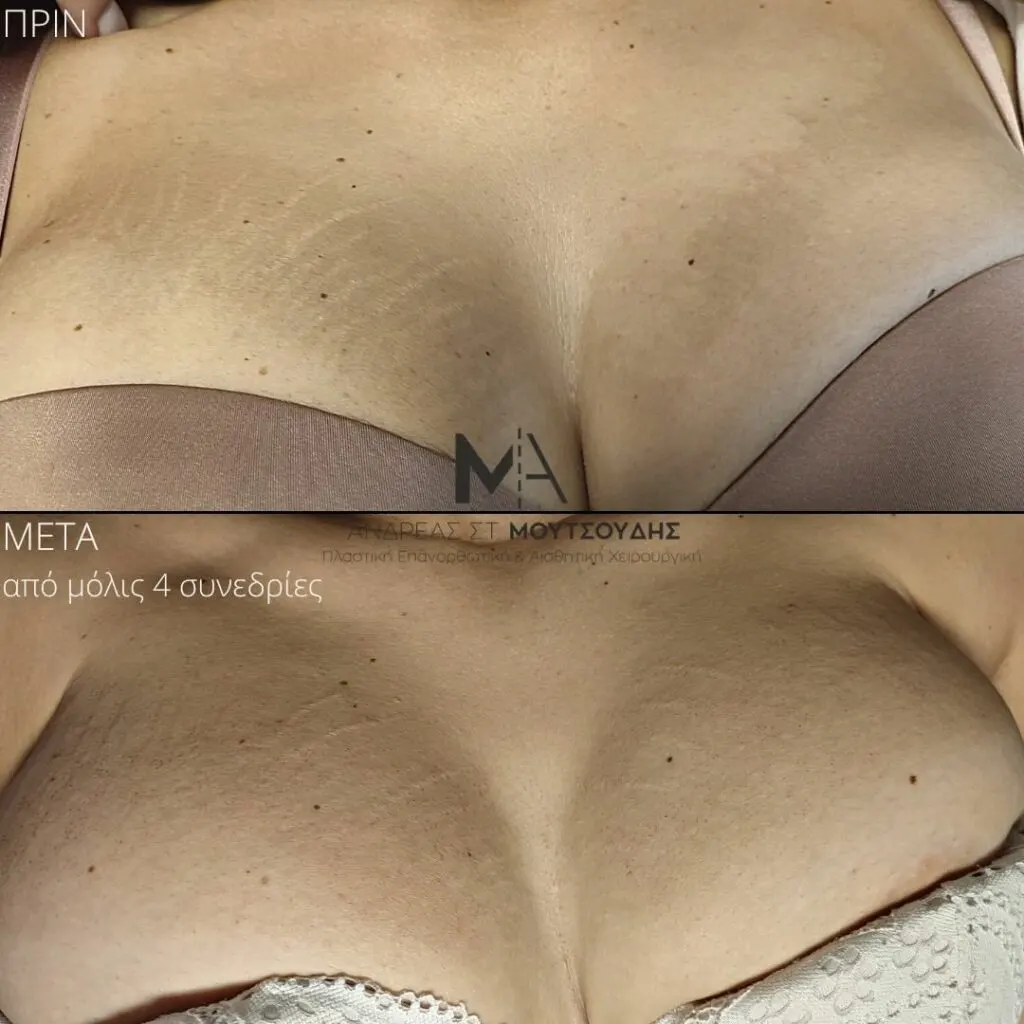 Εφαρμογή του Gentlo αληθινές φωτογραφίες Πριν και Μετά