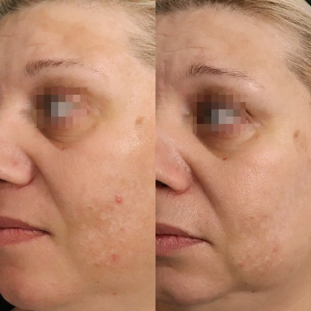 Μεταφλεγμονώδης υπερμελάγχρωση θεραπεία με Gentlo αποτελέσματα μετά από 3 συνεδρίες Gentlo