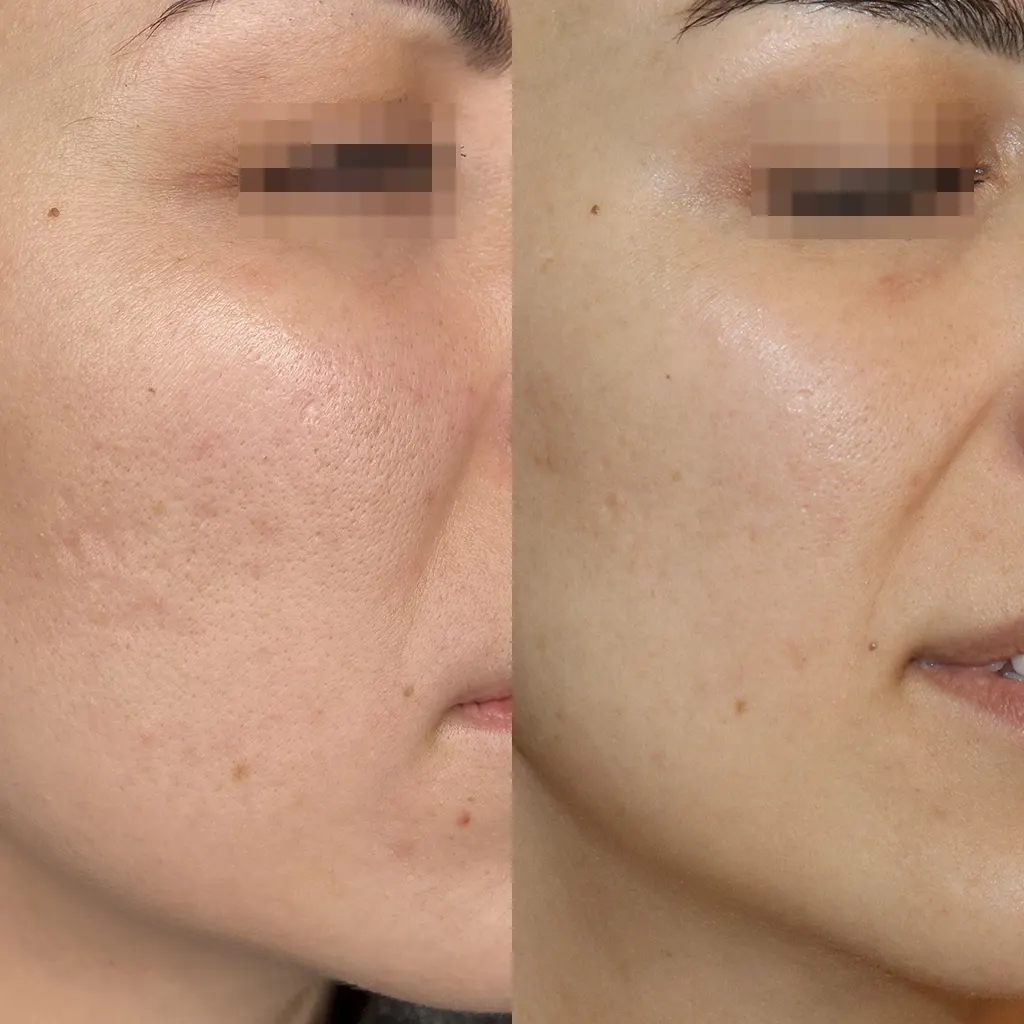 Διεσταλμένοι πόροι δέρματος θεραπεία με Gentlo αποτελέσματα μετά από 5 συνεδρίες Gentlo