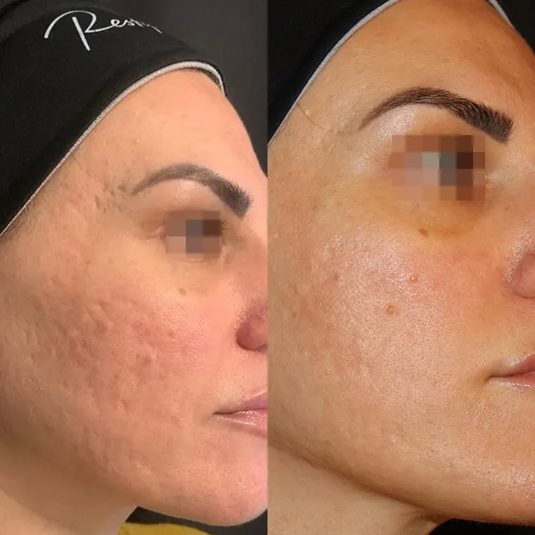 Σημάδια κυστικής ακμής θεραπεία με Gentlo αποτελέσματα μετά από 2 συνεδρίες Gentlo