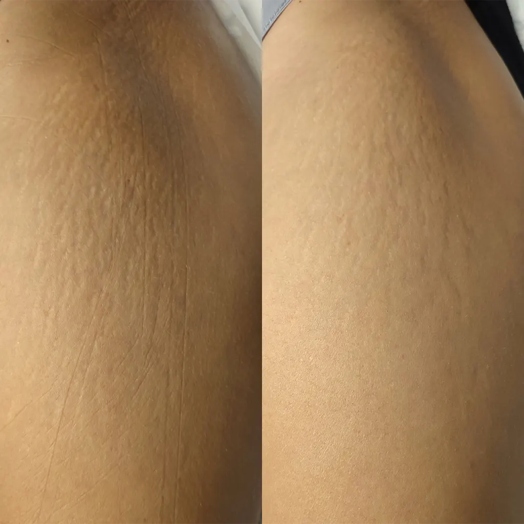 Ραβδώσεις θεραπεία με Gentlo