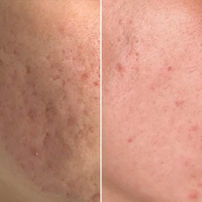 Σημάδια ακμής θεραπεία με Gentlo