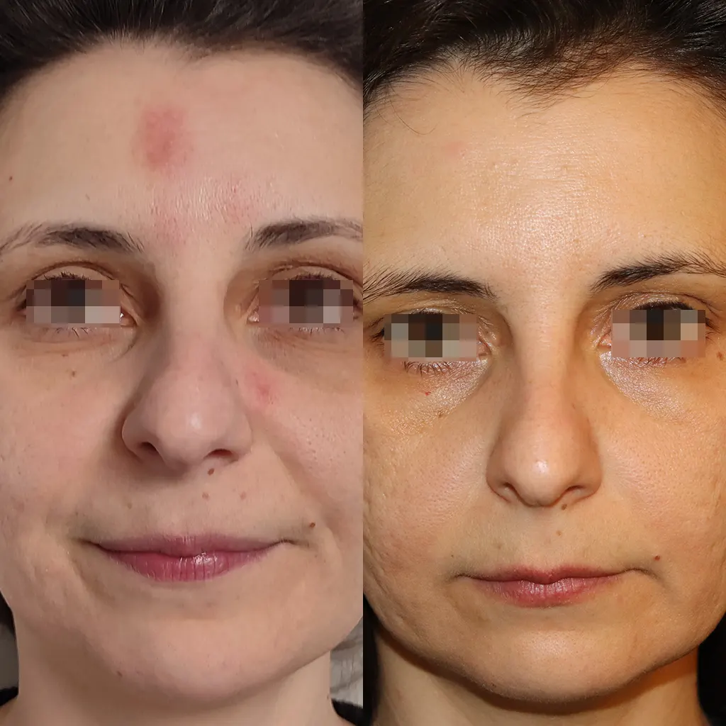 Υπερμελάγχρωση θεραπεία με Gentlo