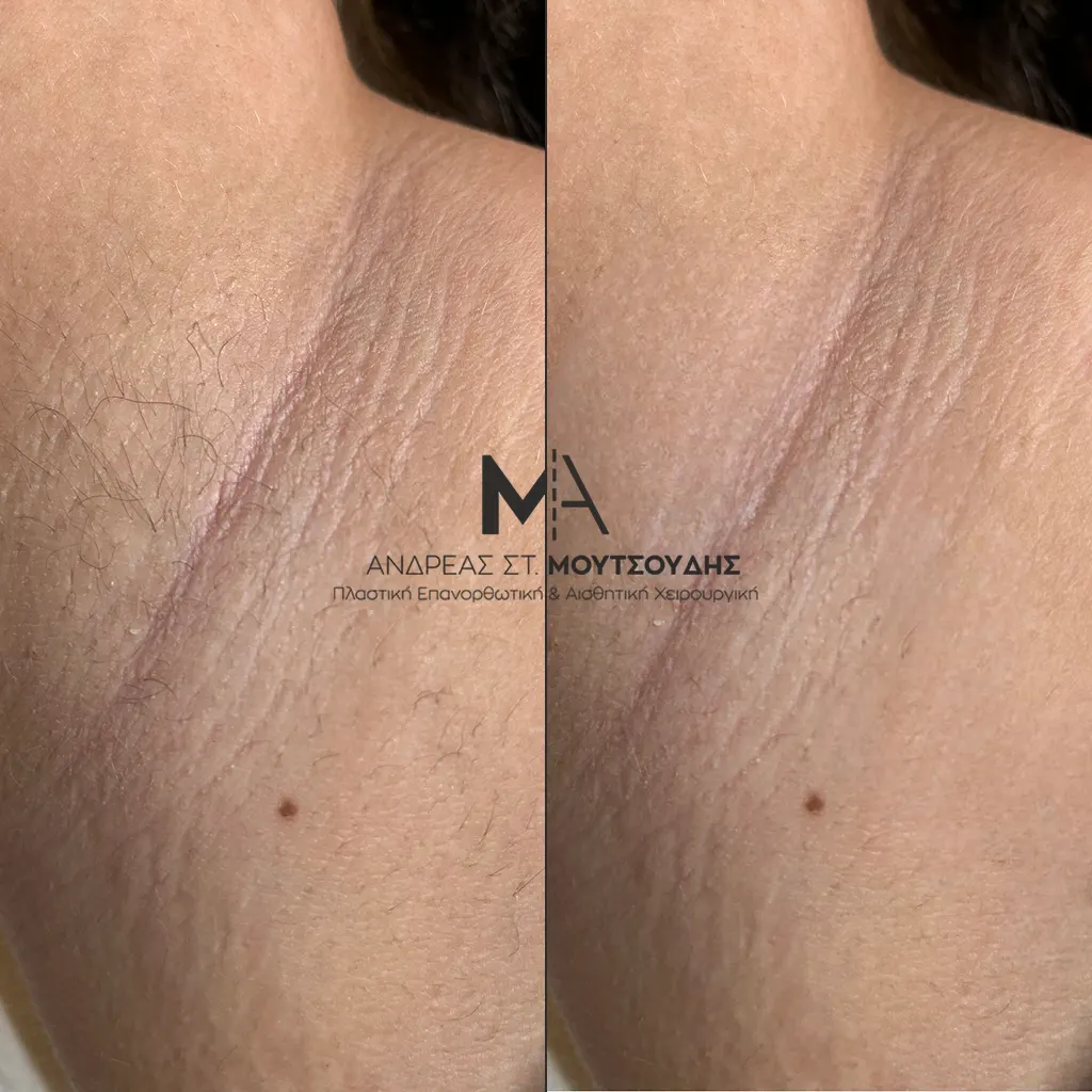 Αποτρίχωση Laser Μπικίνι