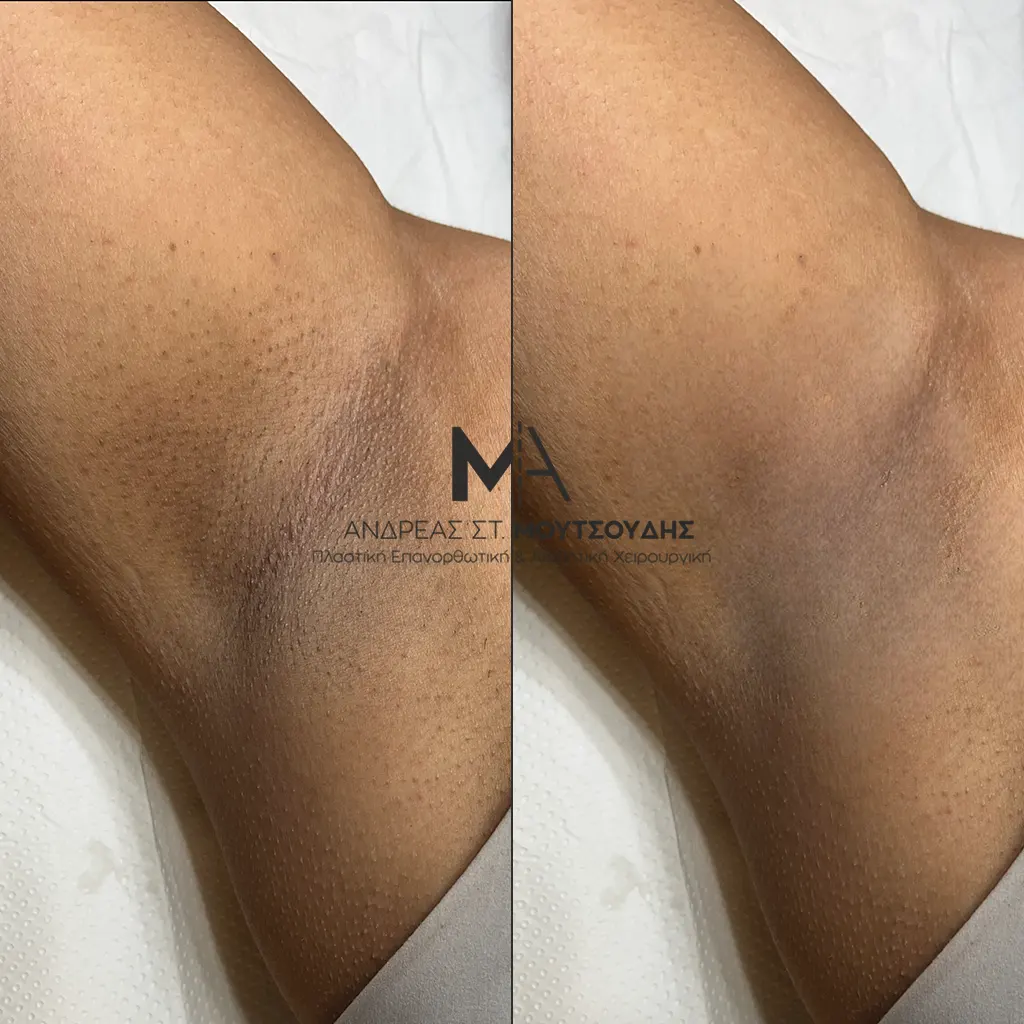 Αποτρίχωση Laser Μασχάλης