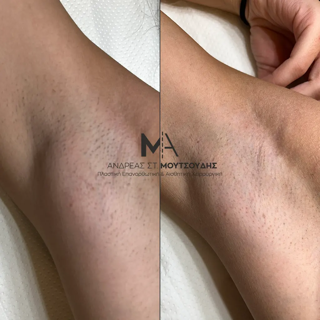 Αποτρίχωση Laser Μασχάλης