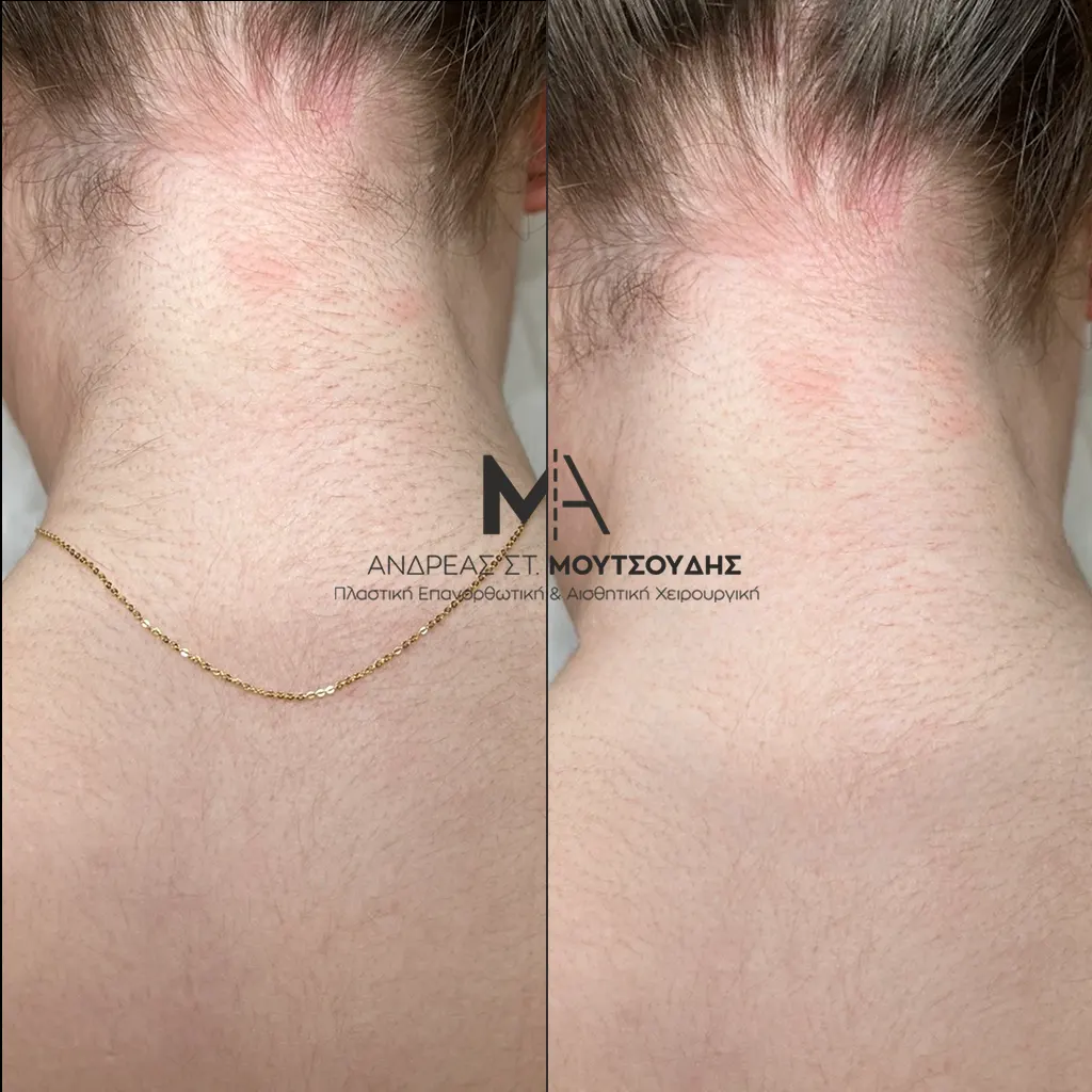 Αποτρίχωση Laser αυχένας