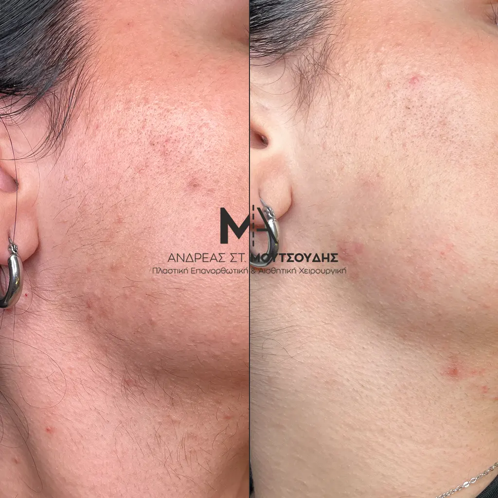 Αποτρίχωση Πρόσωπο