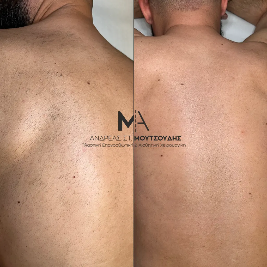 Αποτρίχωση Laser Πλάτη