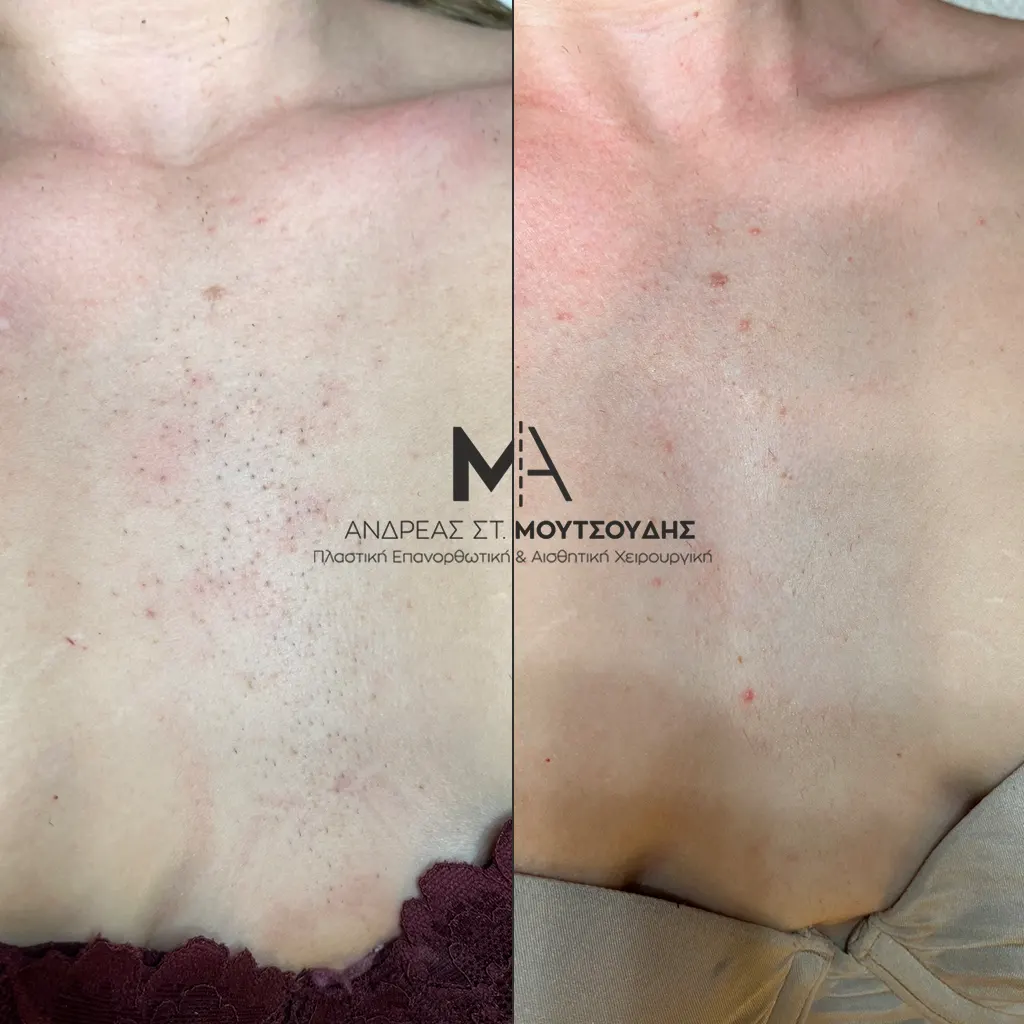 Αποτρίχωση Laser Στήθος για Γυναίκες