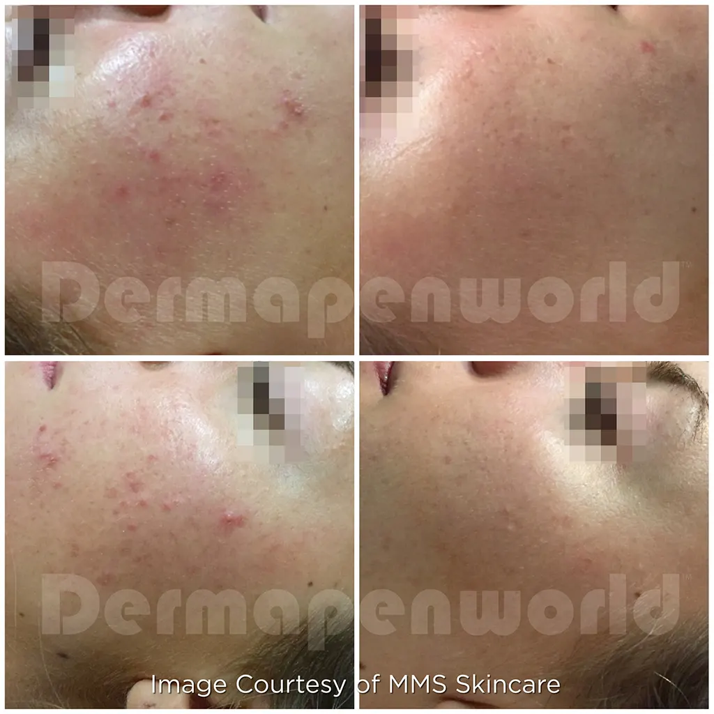 Μεσοθεραπεία με το Dermapen 4 αληθινές φωτογραφίες Πριν και Μετά