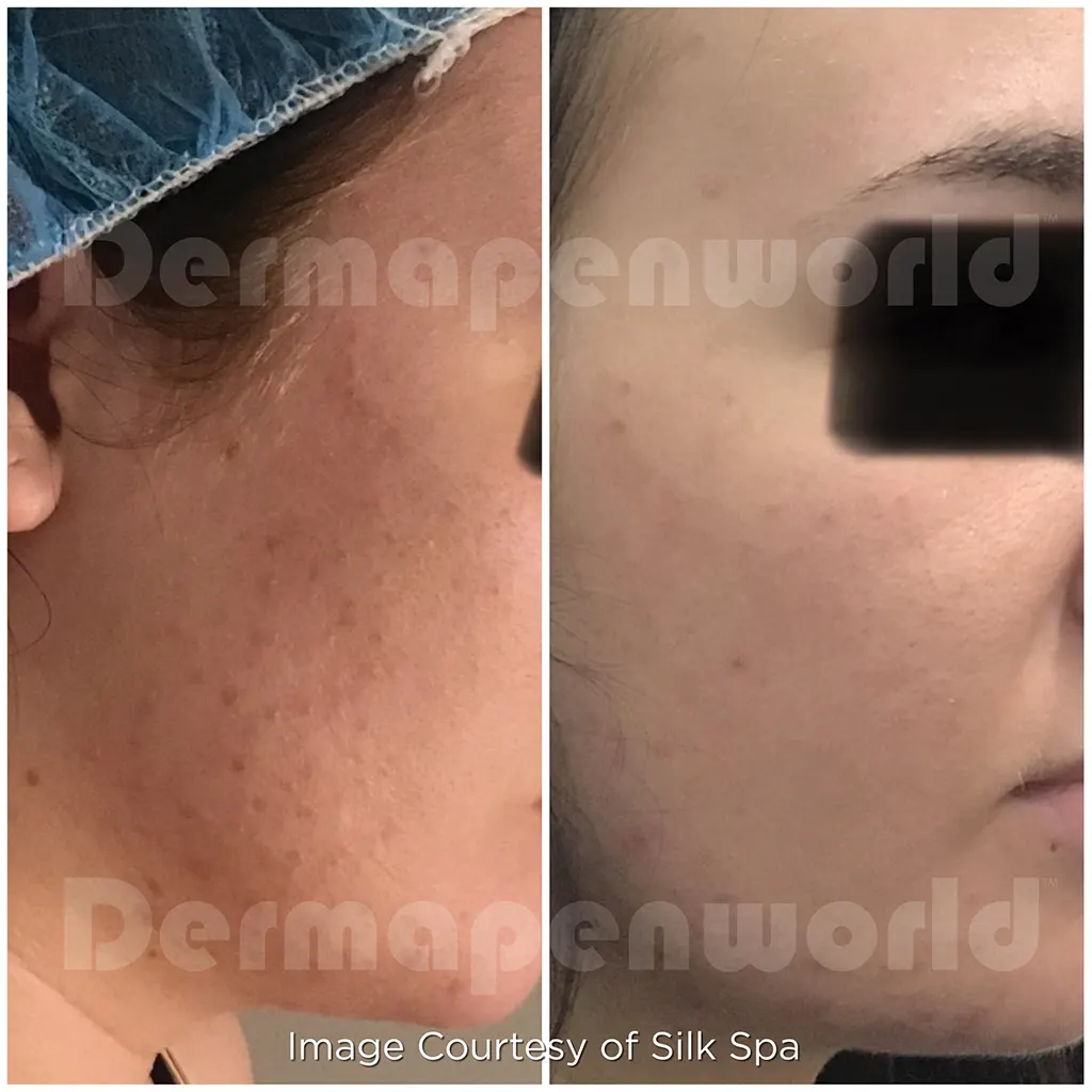 Μεσοθεραπεία με το Dermapen 4 αληθινές φωτογραφίες Πριν και Μετά