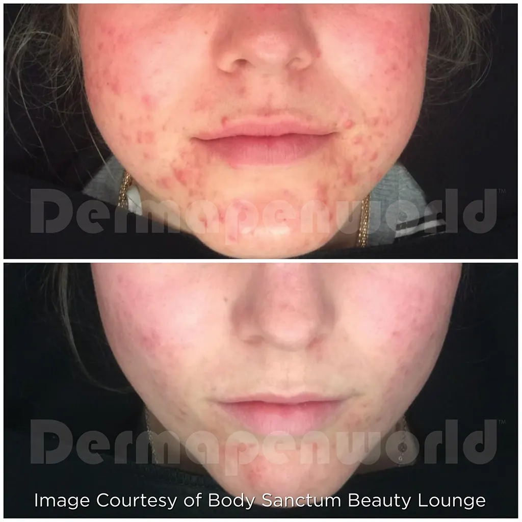 Μεσοθεραπεία με το Dermapen 4 αληθινές φωτογραφίες Πριν και Μετά