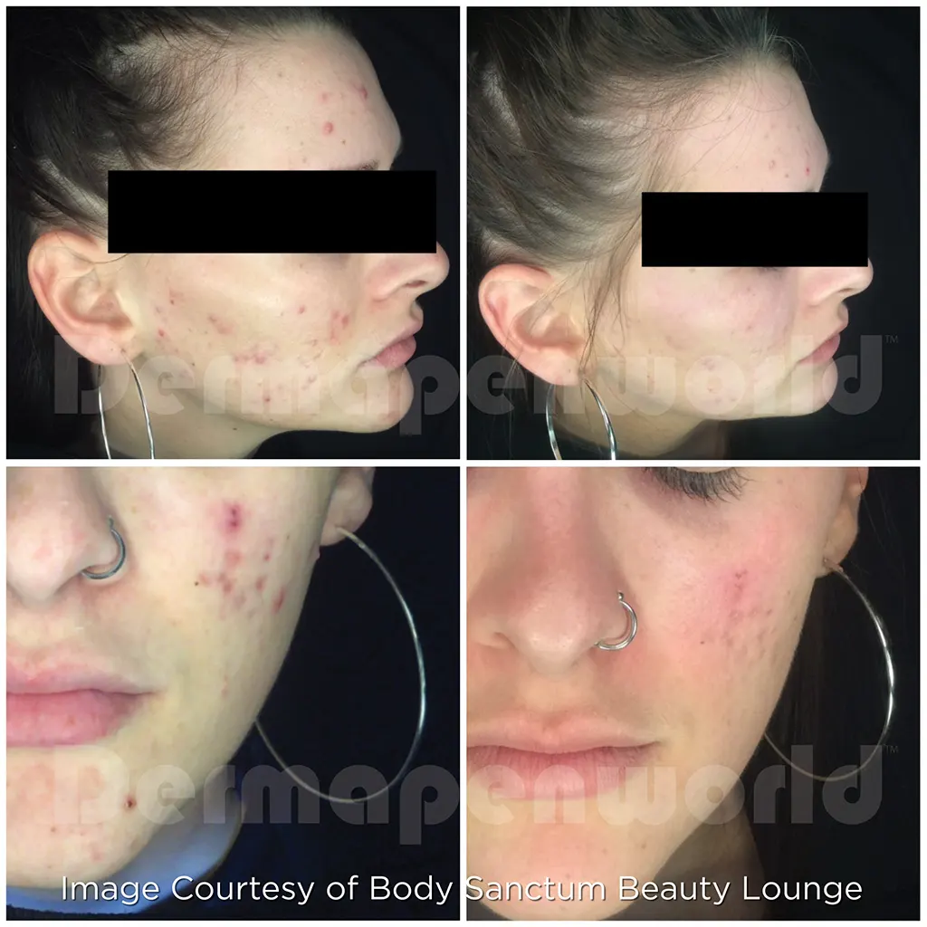 Μεσοθεραπεία με το Dermapen 4 αληθινές φωτογραφίες Πριν και Μετά