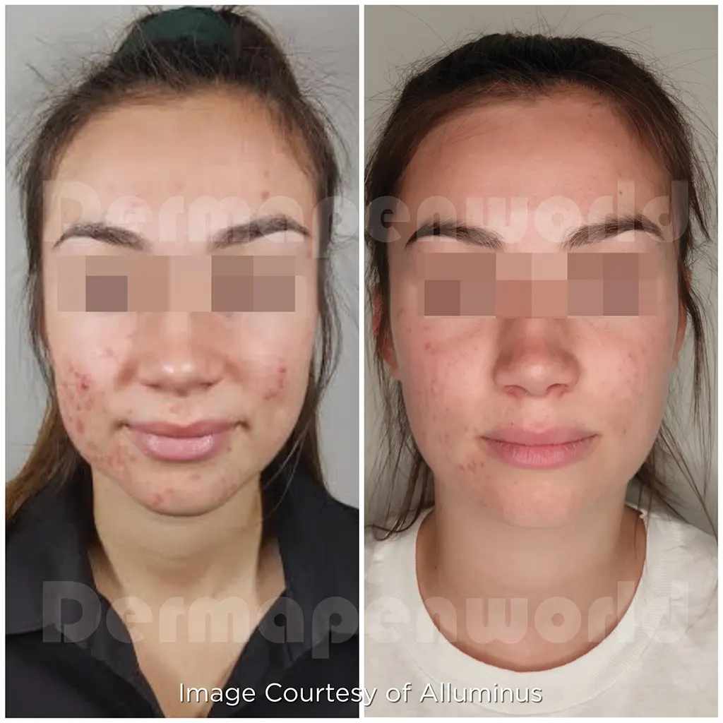 Μεσοθεραπεία με το Dermapen 4 αληθινές φωτογραφίες Πριν και Μετά