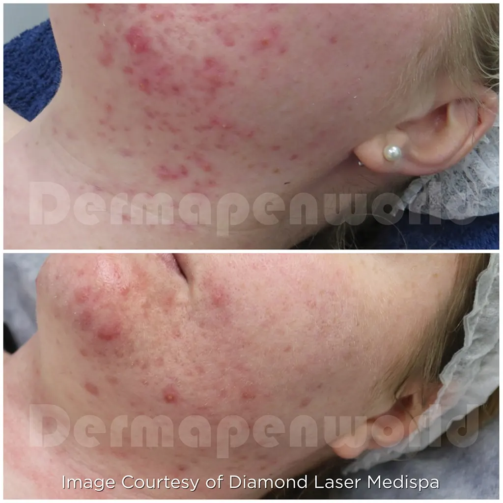 Μεσοθεραπεία με το Dermapen 4 αληθινές φωτογραφίες Πριν και Μετά