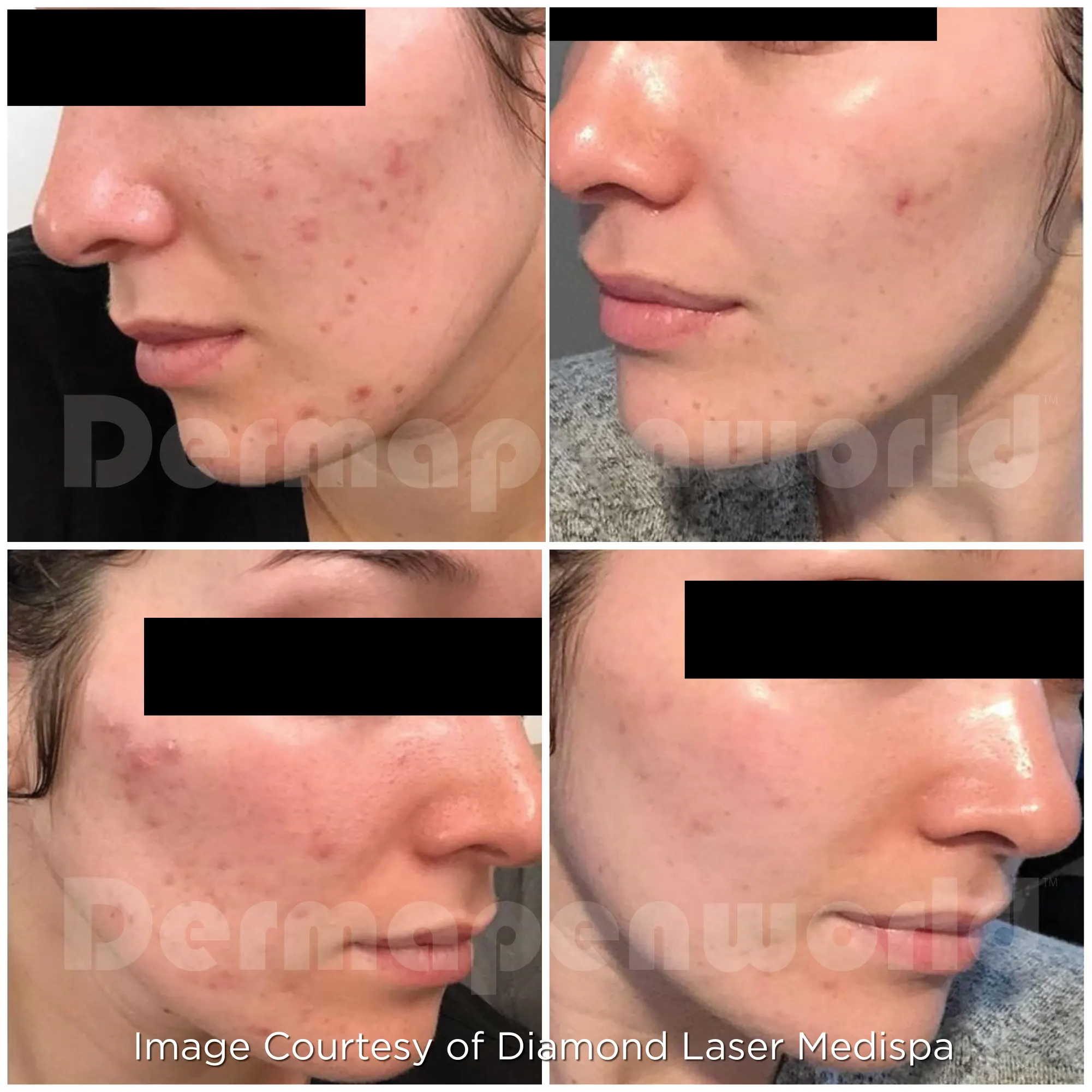 Μεσοθεραπεία με το Dermapen 4 αληθινές φωτογραφίες Πριν και Μετά