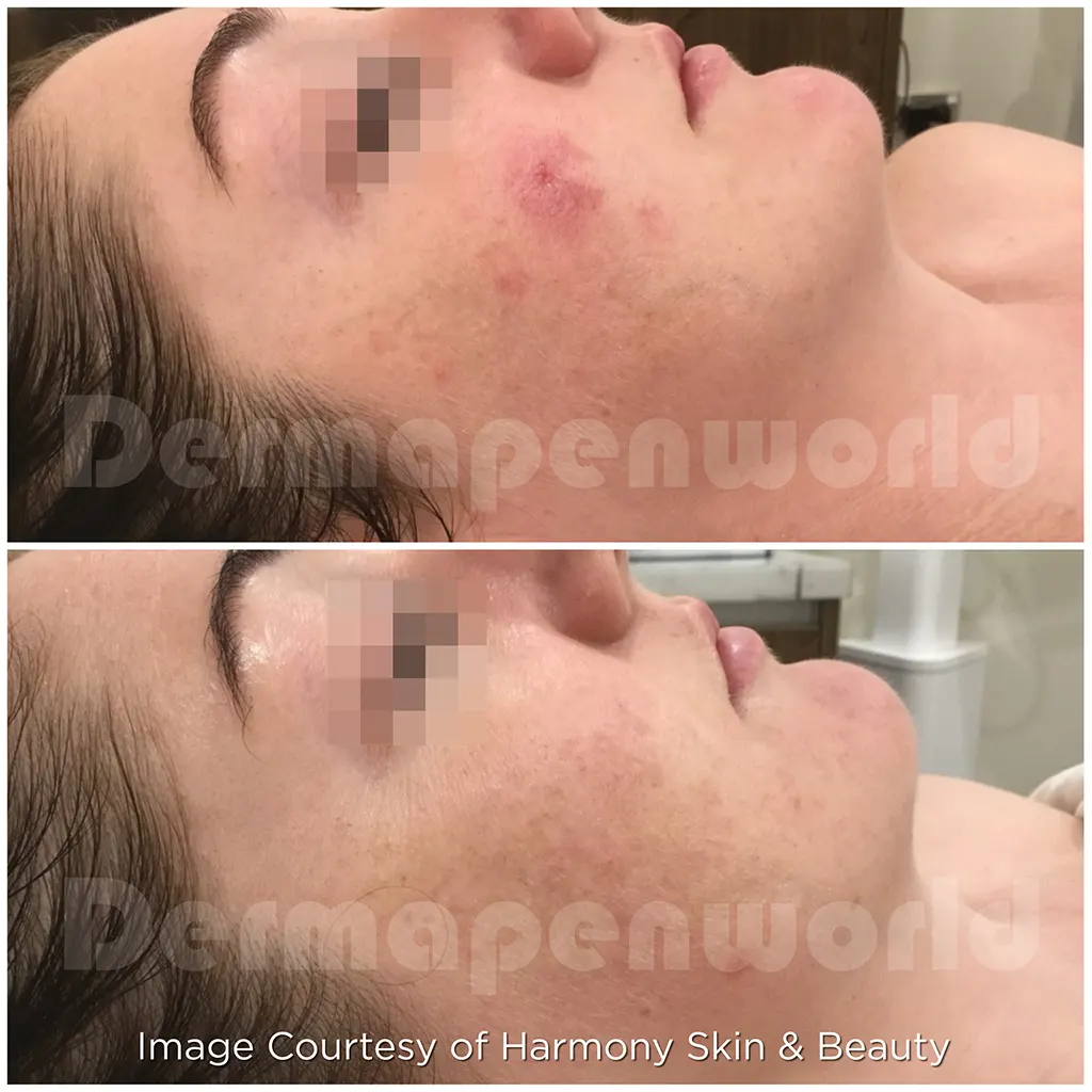 Μεσοθεραπεία με το Dermapen 4 αληθινές φωτογραφίες Πριν και Μετά