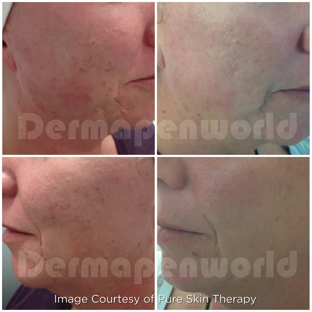 Μεσοθεραπεία με το Dermapen 4 αληθινές φωτογραφίες Πριν και Μετά
