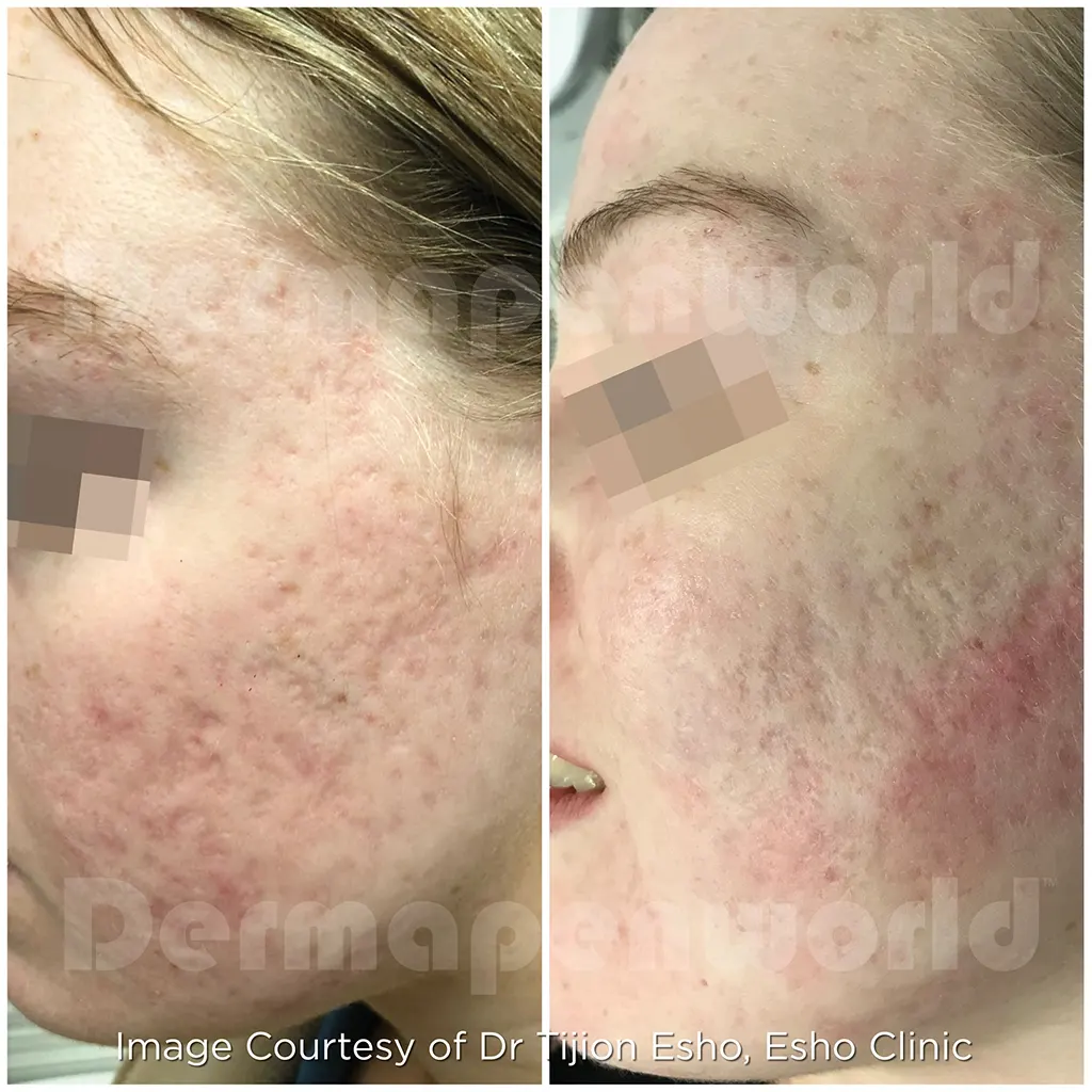 Μεσοθεραπεία με το Dermapen 4 αληθινές φωτογραφίες Πριν και Μετά