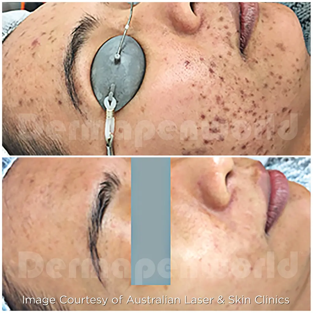 Μεσοθεραπεία με το Dermapen 4 αληθινές φωτογραφίες Πριν και Μετά