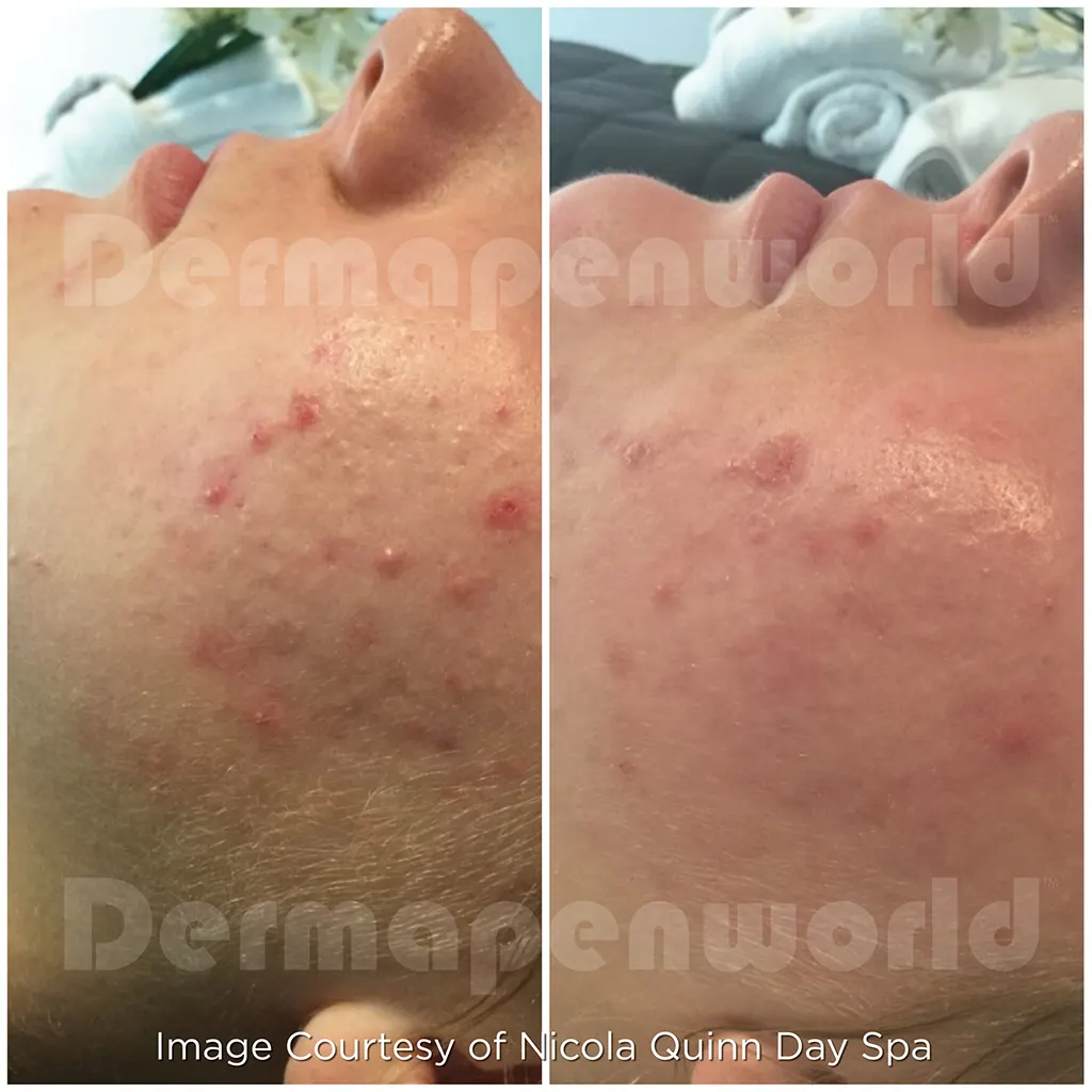 Μεσοθεραπεία με το Dermapen 4 αληθινές φωτογραφίες Πριν και Μετά