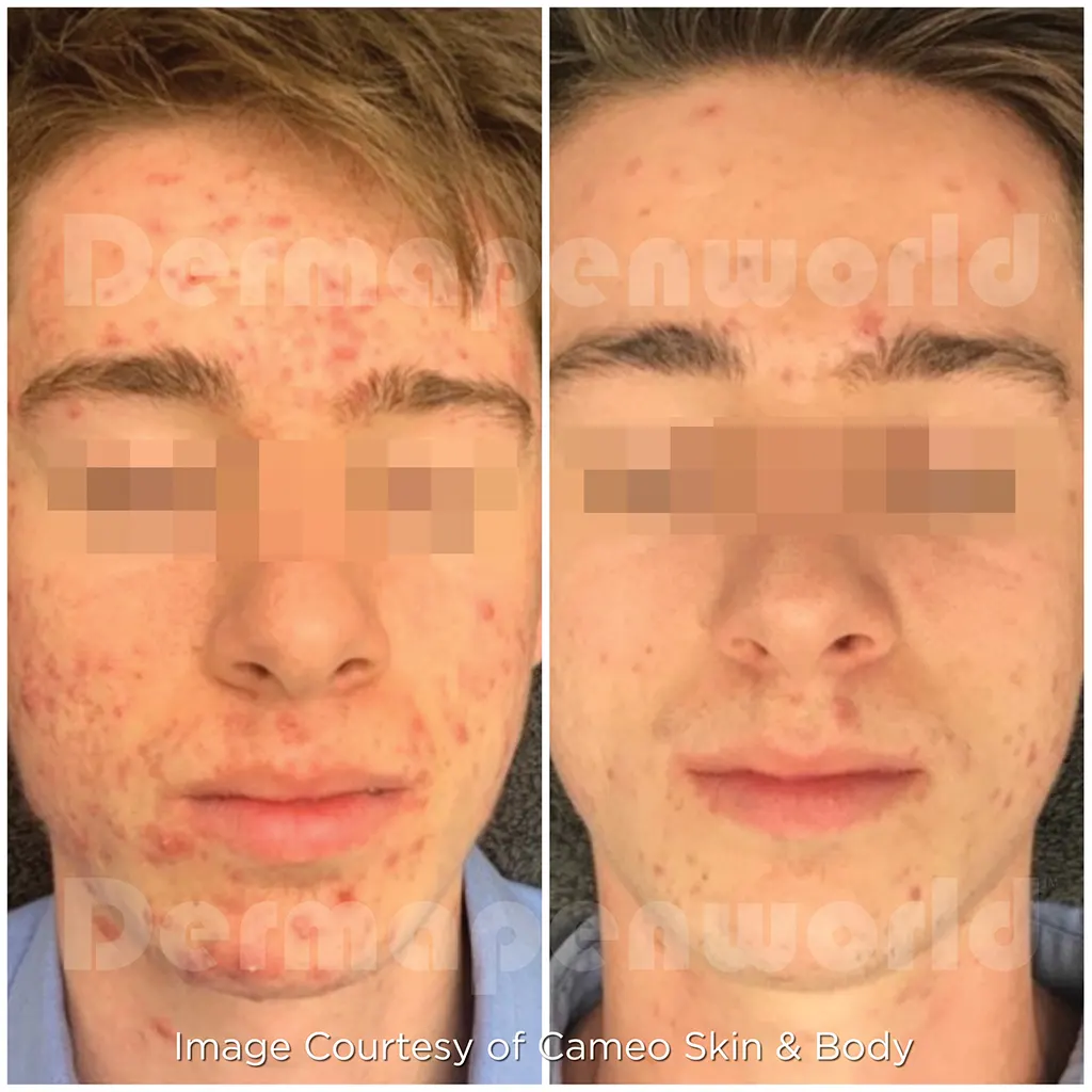 Μεσοθεραπεία με το Dermapen 4 αληθινές φωτογραφίες Πριν και Μετά