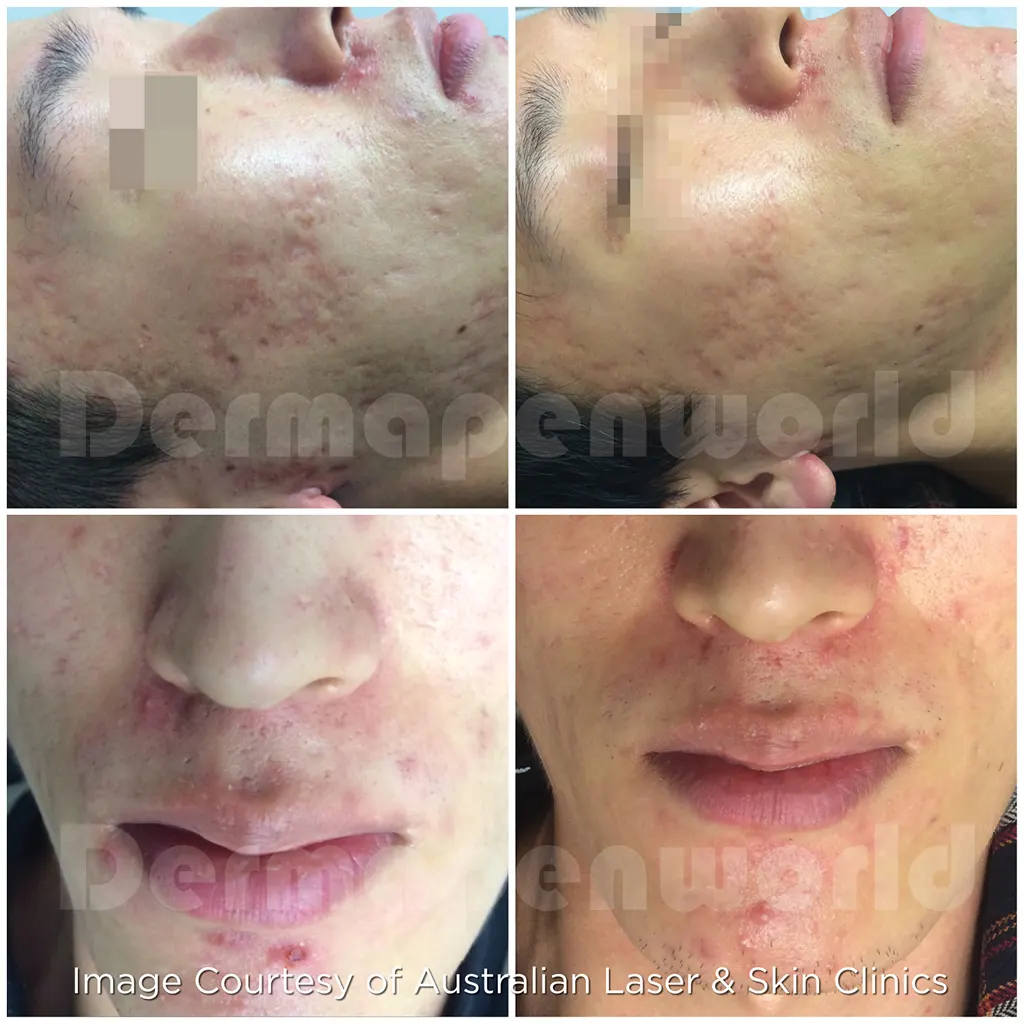 Μεσοθεραπεία με το Dermapen 4 αληθινές φωτογραφίες Πριν και Μετά