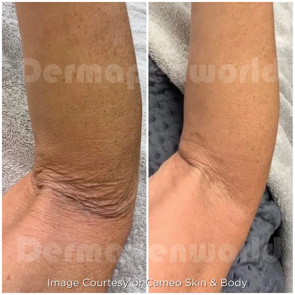 Μεσοθεραπεία με το Dermapen 4 αληθινές φωτογραφίες Πριν και Μετά