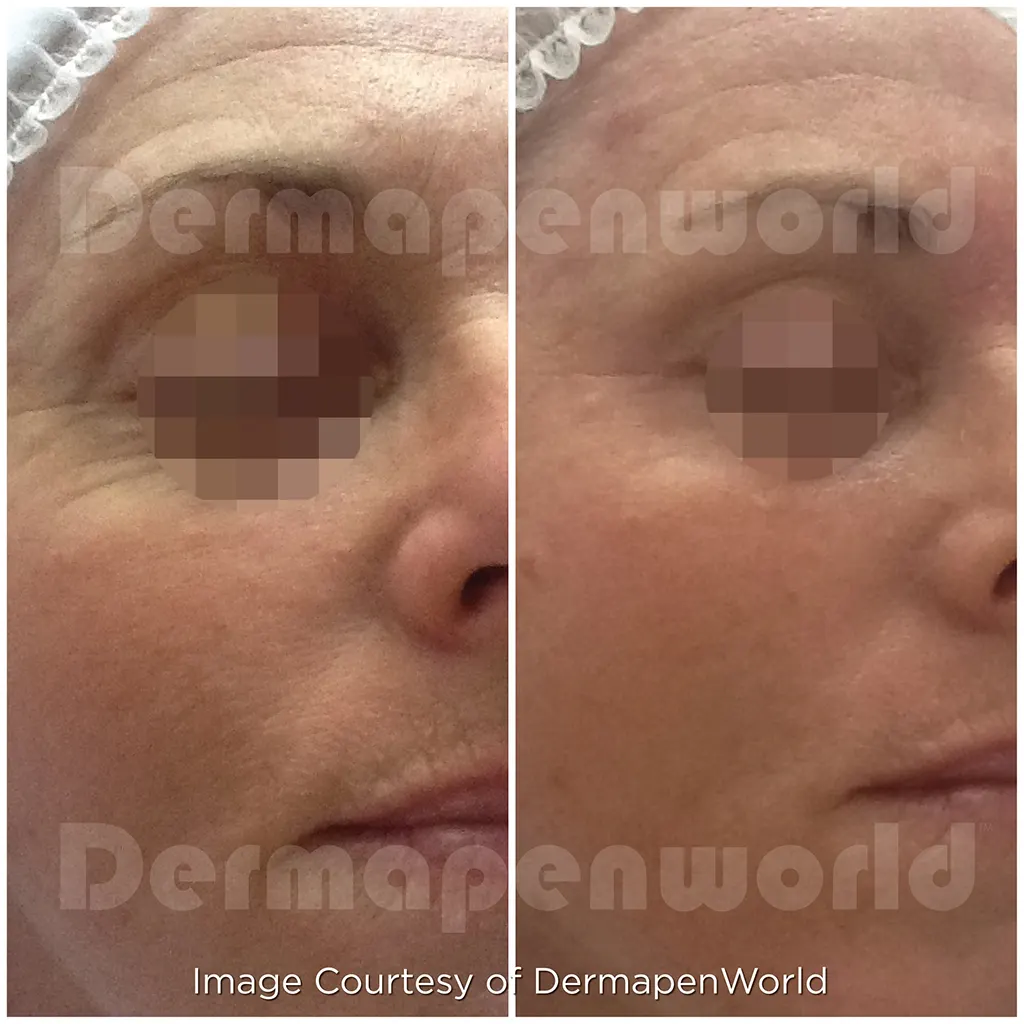 Μεσοθεραπεία με το Dermapen 4 αληθινές φωτογραφίες Πριν και Μετά