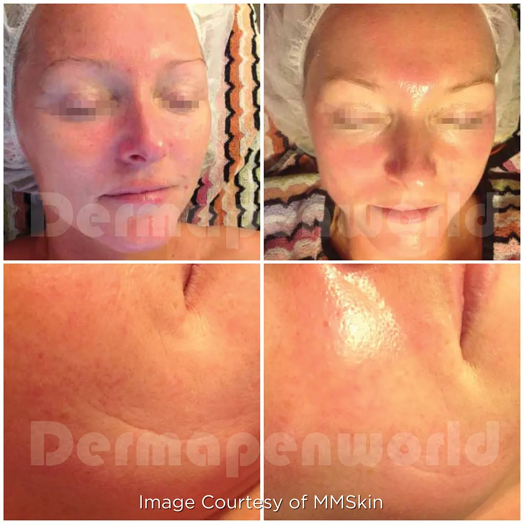 Μεσοθεραπεία με το Dermapen 4 αληθινές φωτογραφίες Πριν και Μετά