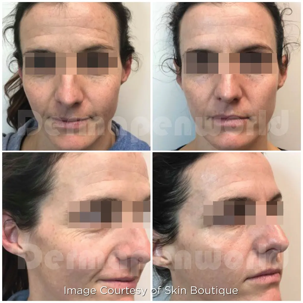 Μεσοθεραπεία με το Dermapen 4 αληθινές φωτογραφίες Πριν και Μετά