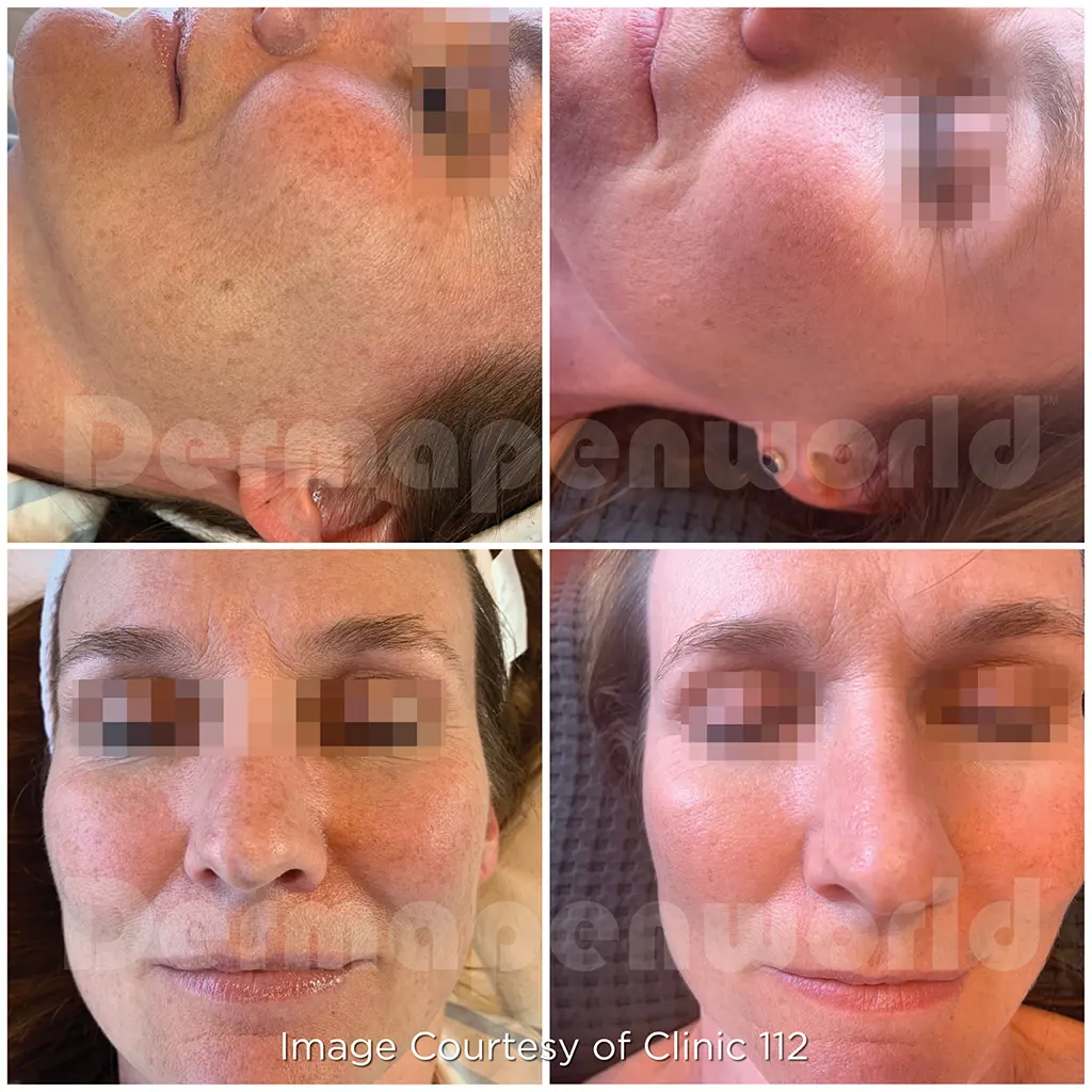 Μεσοθεραπεία με το Dermapen 4 αληθινές φωτογραφίες Πριν και Μετά