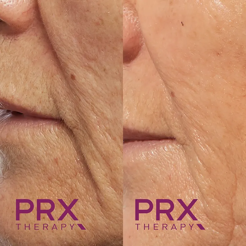 PRX Peeling μέσα αληθινές εικόνες Πριν και Μετά